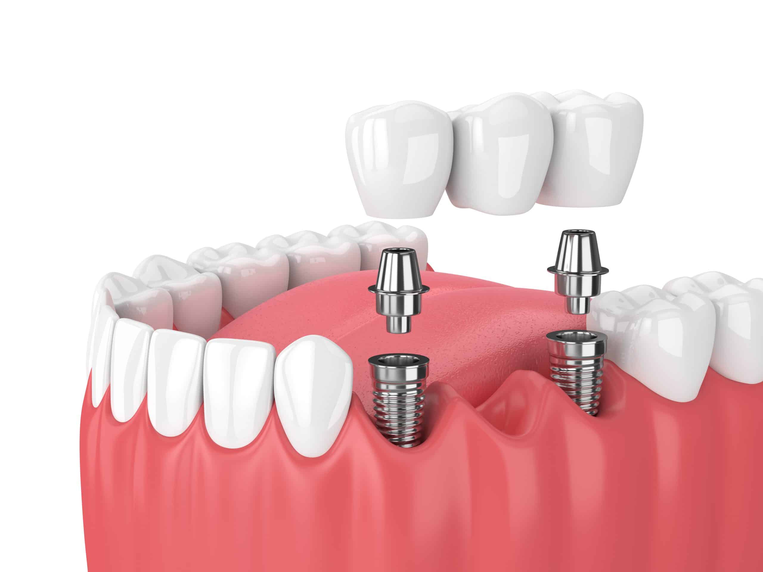 3d render of jaw and implants with dental bridge