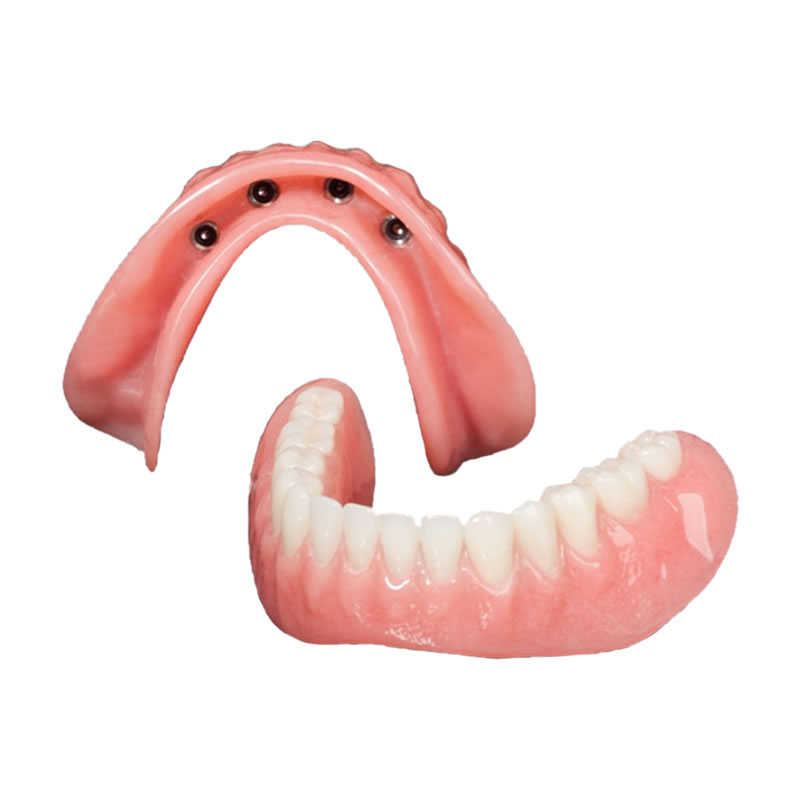 implant overdenture sq