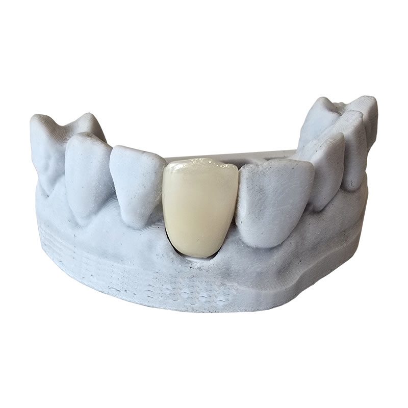 veneer